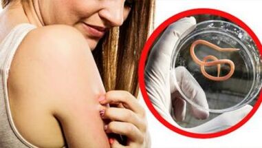 Une éruption cutanée sur le corps est un signe d'infection par les helminthes